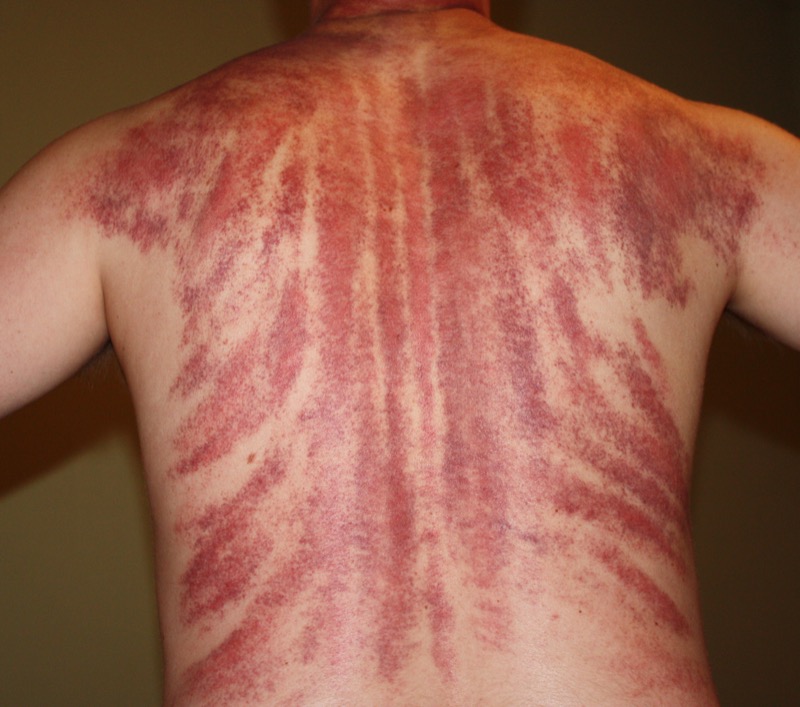 Gua Sha